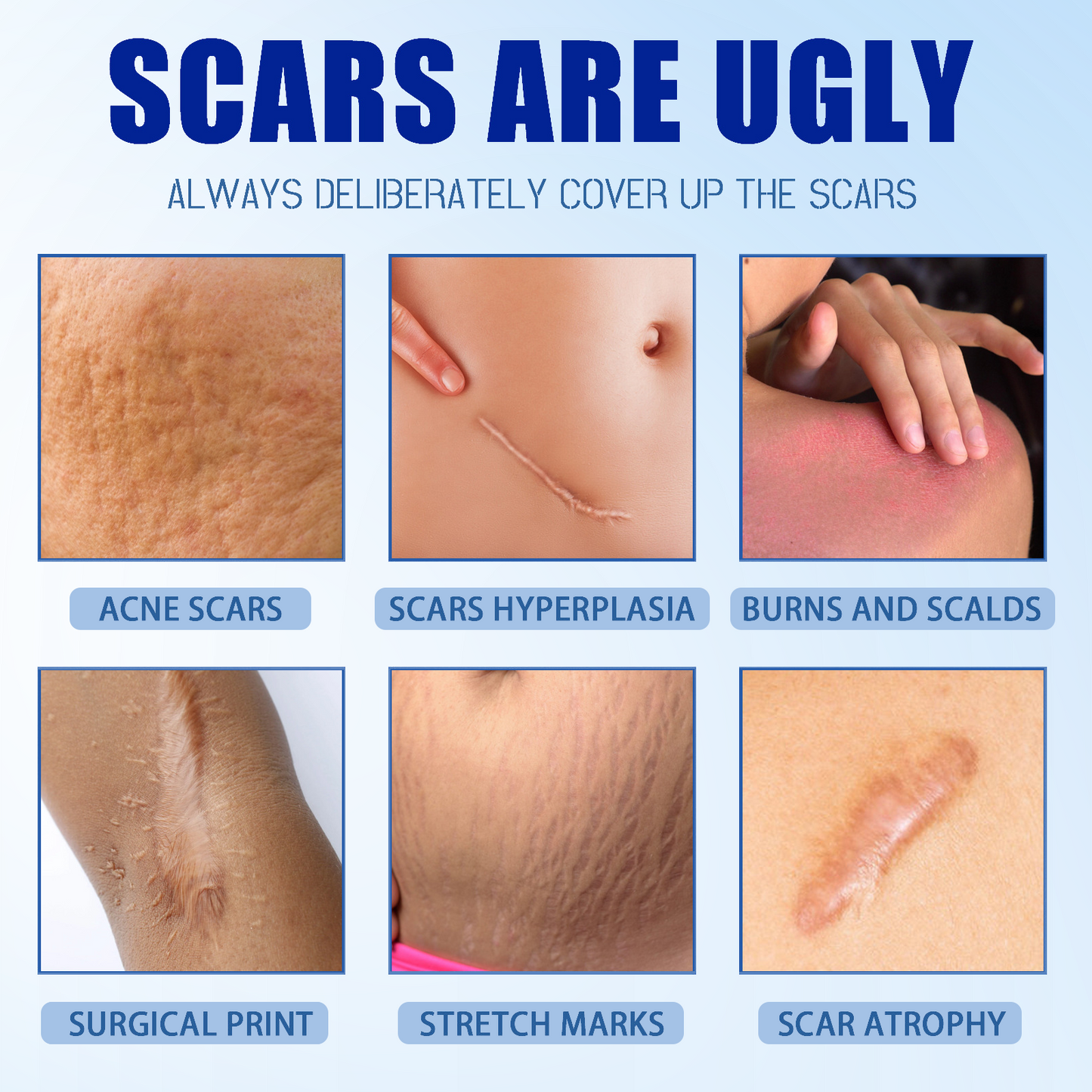 🔥SKAVIX™Professional Scar Removal Gel- Scarremoval treatment for keloids, C-sectionS, surgeries, burns, acne andmore.