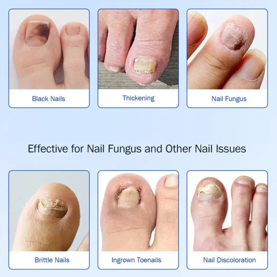 🔥SKAVIX™Fungal Nail Patches, 21pcs/box Nail Health Care Patches, Nail Fungus Care Patches, Suitable for Solving Fungal Nails and Other Nail Problems, Nail Supplies, Daily Care Nails Kit Set
